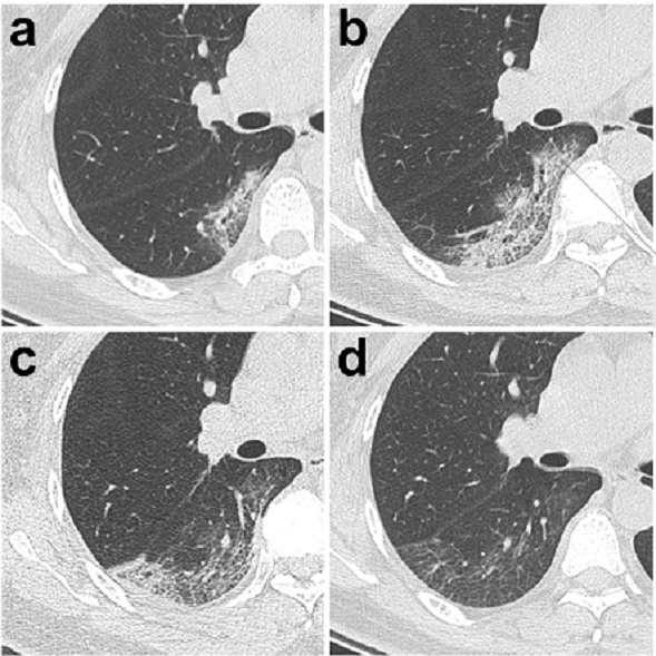 CT demonstrating a moderate pneumonia with resolution, Pan et al Radiol 2020 in press 